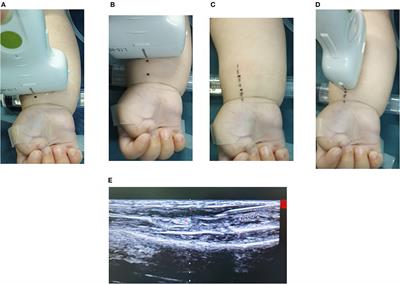 Modified Long-Axis In-plane Technique for Radial Artery Cannulation in Children: A Randomized Controlled Trial